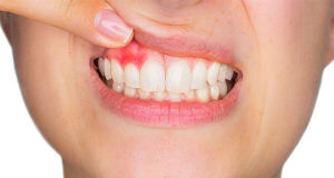 Gum treatment in Delhi